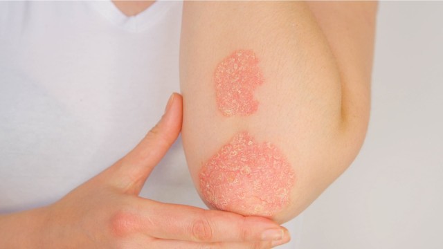 Psoriazisul îți provoacă oboseala?